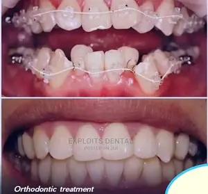 Teeth Aligment