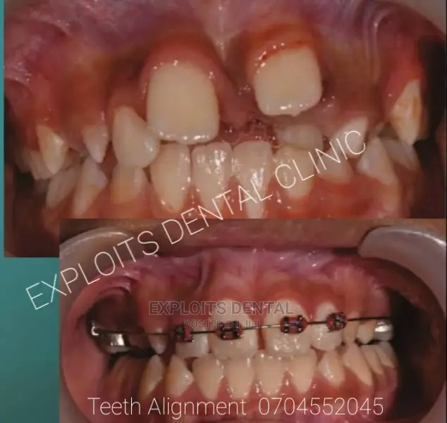 Teeth Alignment Using Braces