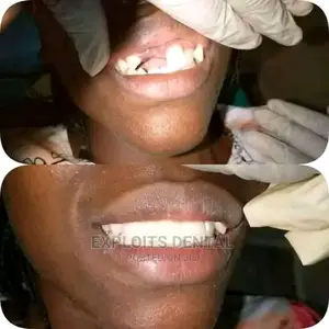 Teeth Replacement ( Pfm Brigde)