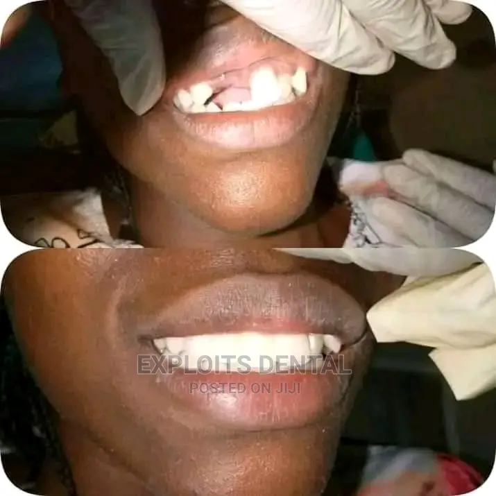 Teeth Replacement ( Pfm Brigde)