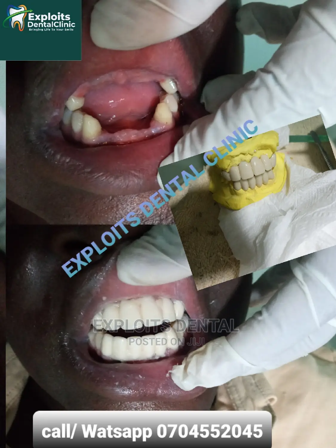 Artificial Teeth ( Bridge , Crowns , Dentures )