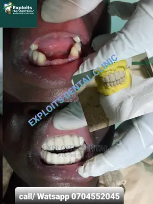 Artificial Teeth ( Bridge , Crowns , Dentures )