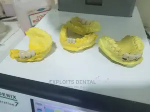 Pfm Crowns Bridges (Smile Restoration )