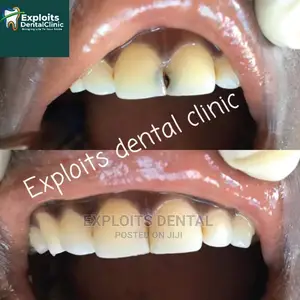 Composite Filling and Crowns