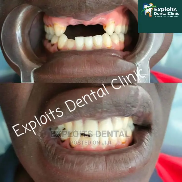 Pfm Bridge( Artificial Teeth)