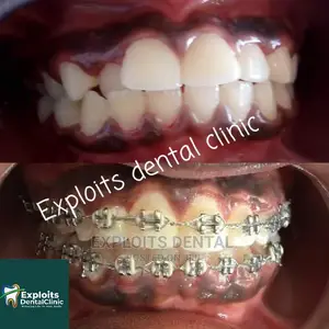 Teeth Alignment