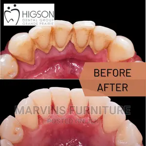 Professional Teeth Cleaning