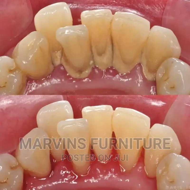 Professional Teeth Cleaning