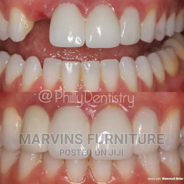 Fixing Missing Teeth