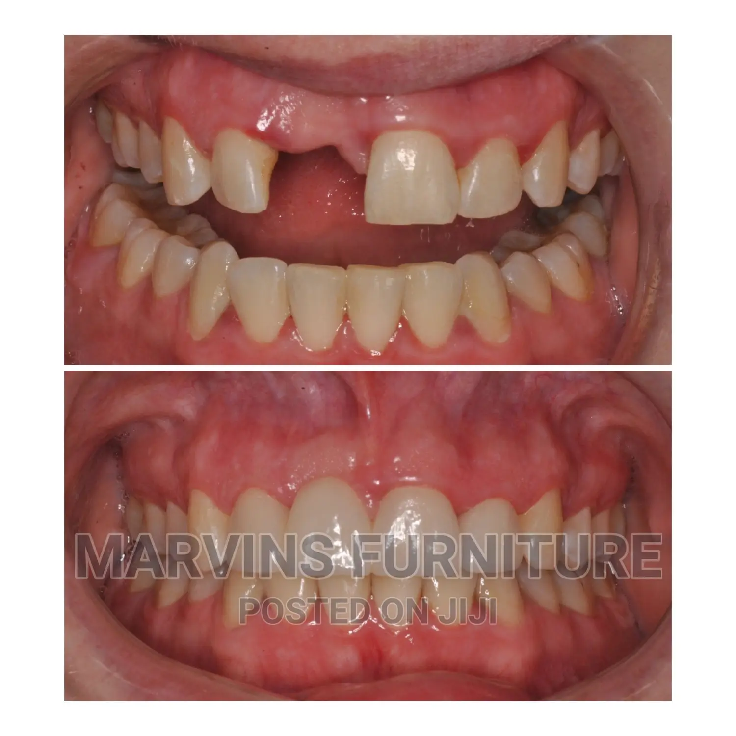 Fixing Missing Teeth