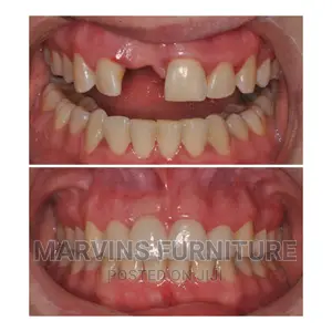 Fixing Missing Teeth