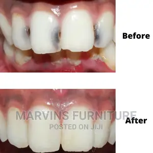 We Repair Decayed Teeth to Normal Colourand Shape