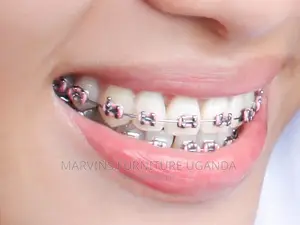Braces to Correct Malalligned Teeth and Bites