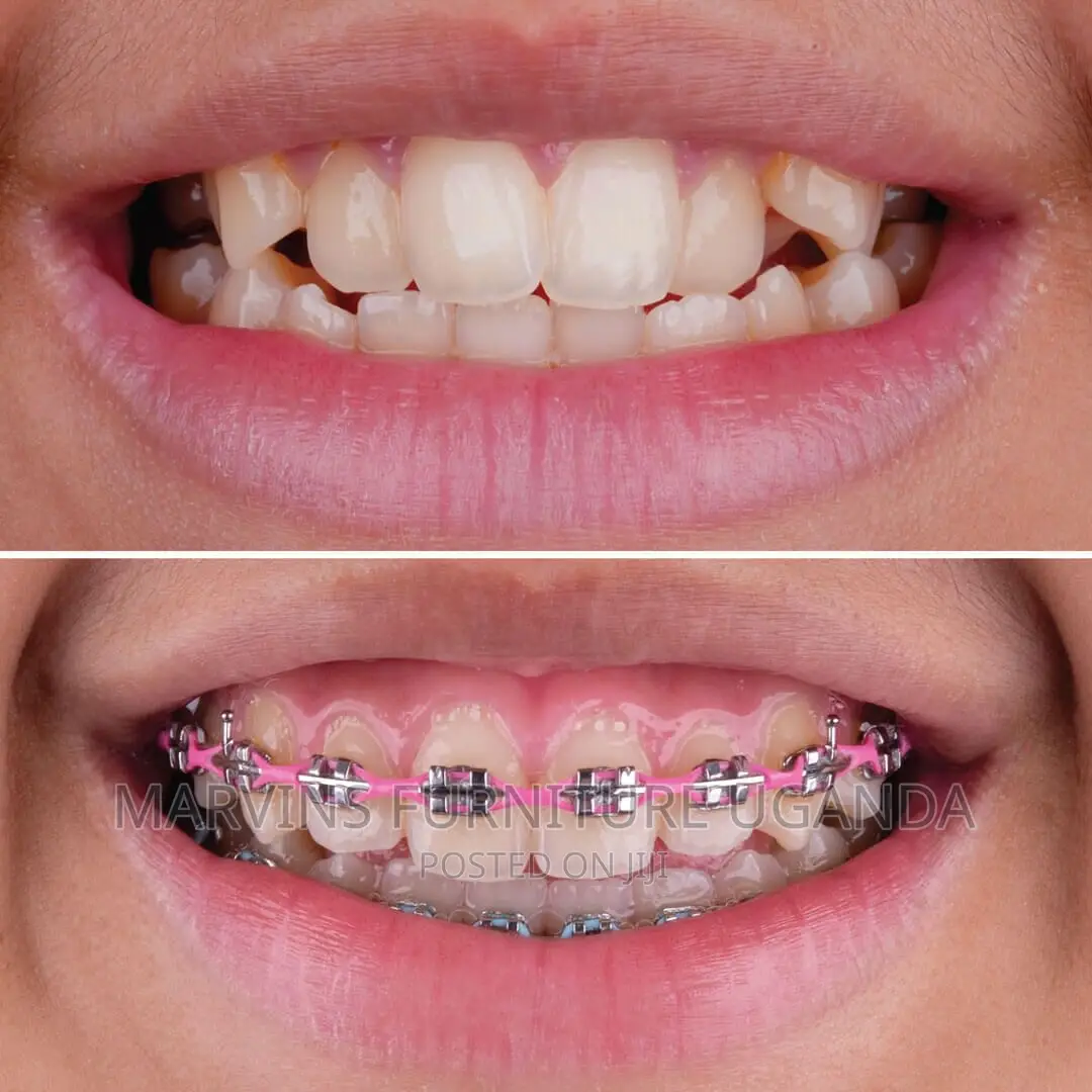 Teeth Braces