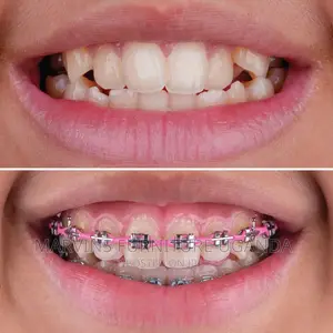 Teeth Braces