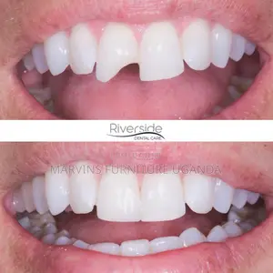 Broken ,Cracked or Chipped Teeth
