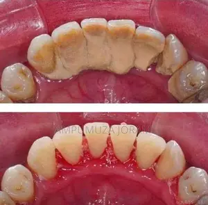 Teeth Cleaning