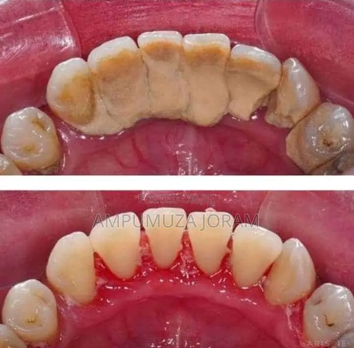 Teeth Cleaning