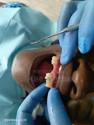 Teeth Replacement