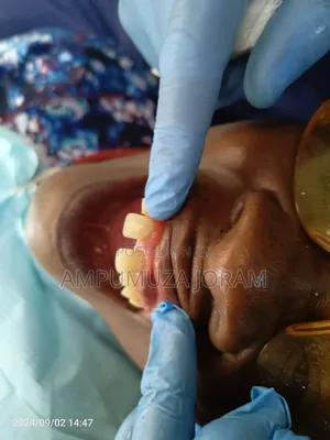 Teeth Replacement