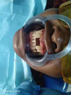 Teeth Replacement