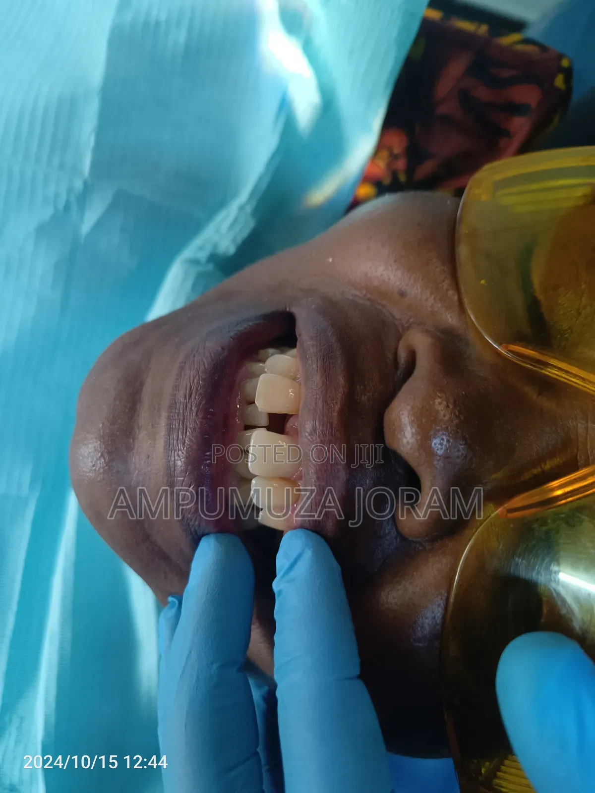Teeth Replacement
