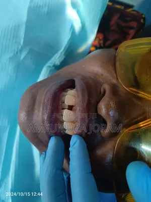 Teeth Replacement