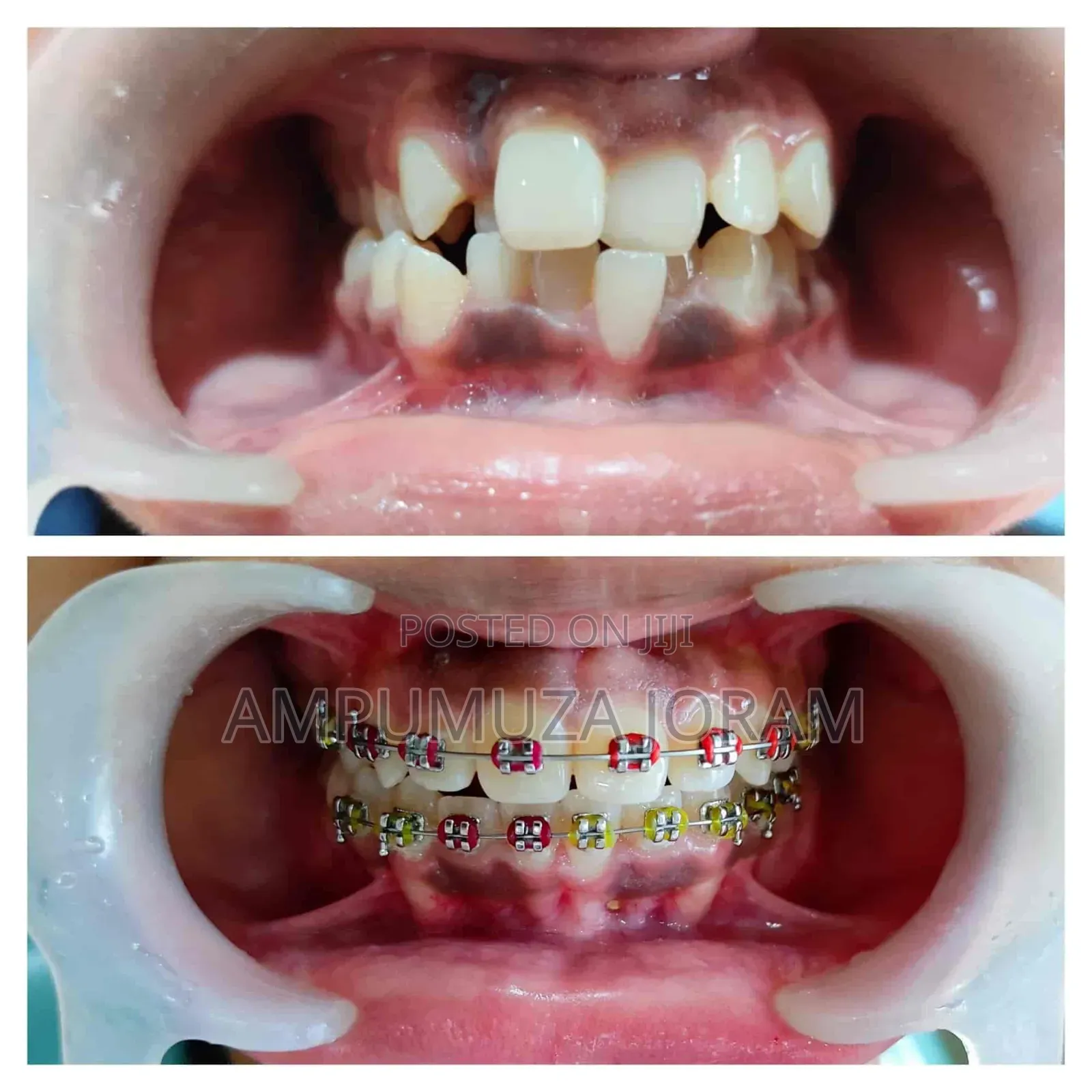 Braces for Teeth Alignment