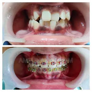 Braces for Teeth Alignment