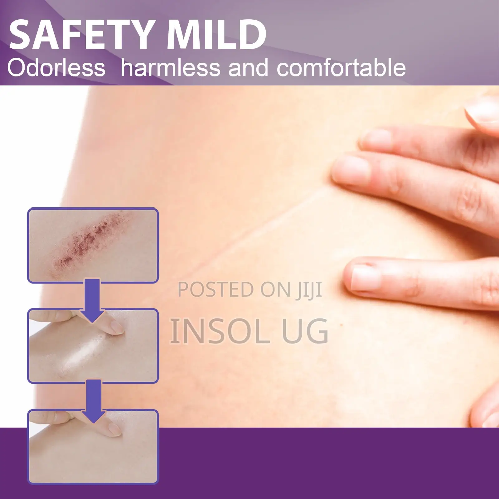 Silicone Scar Remover