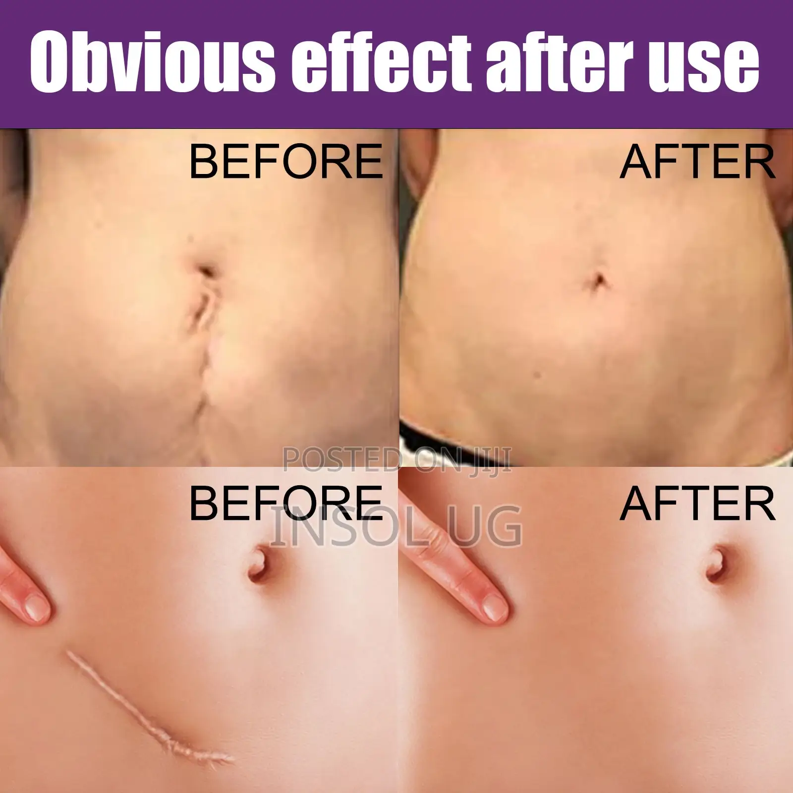 Silicone Scar Remover