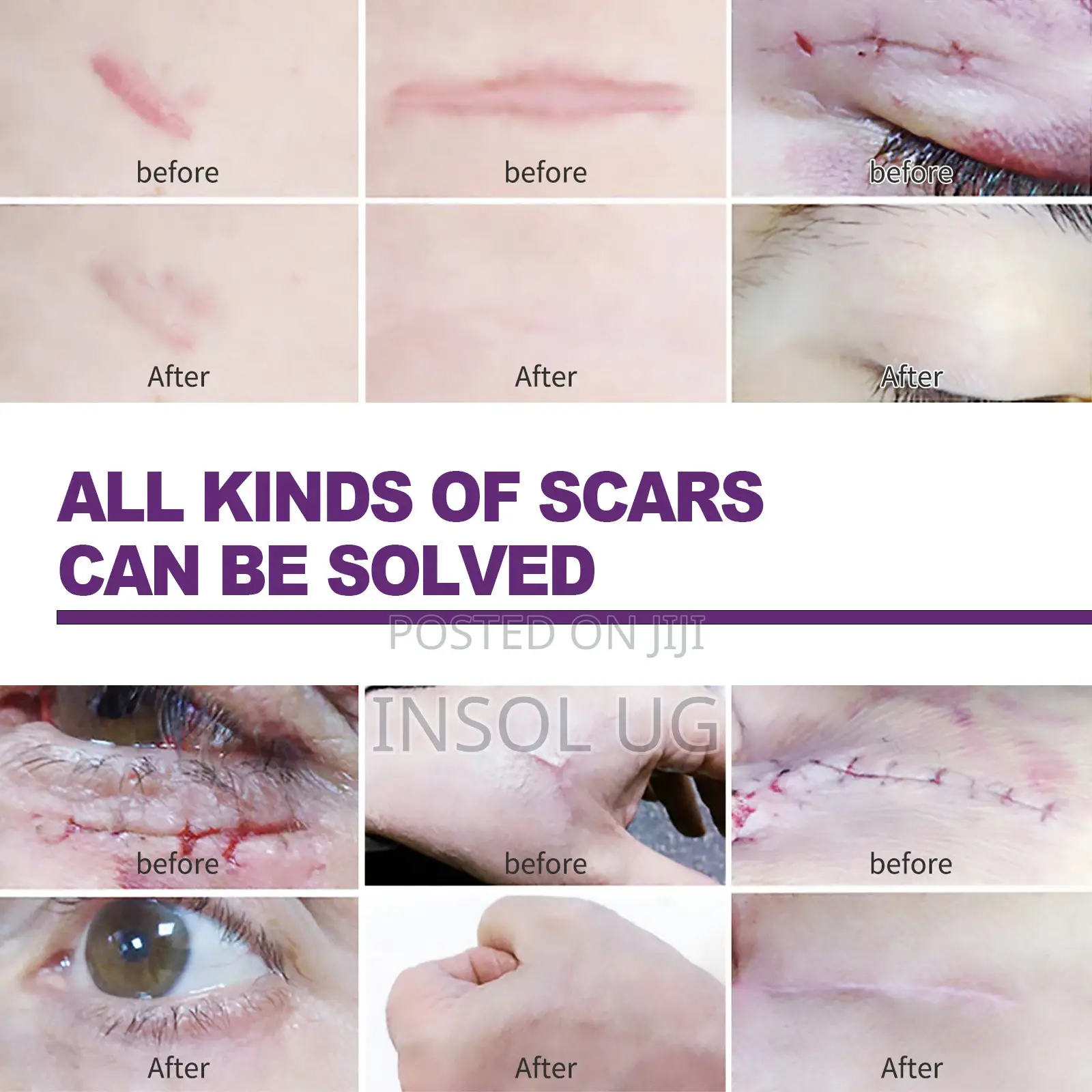 Silicone Scar Remover