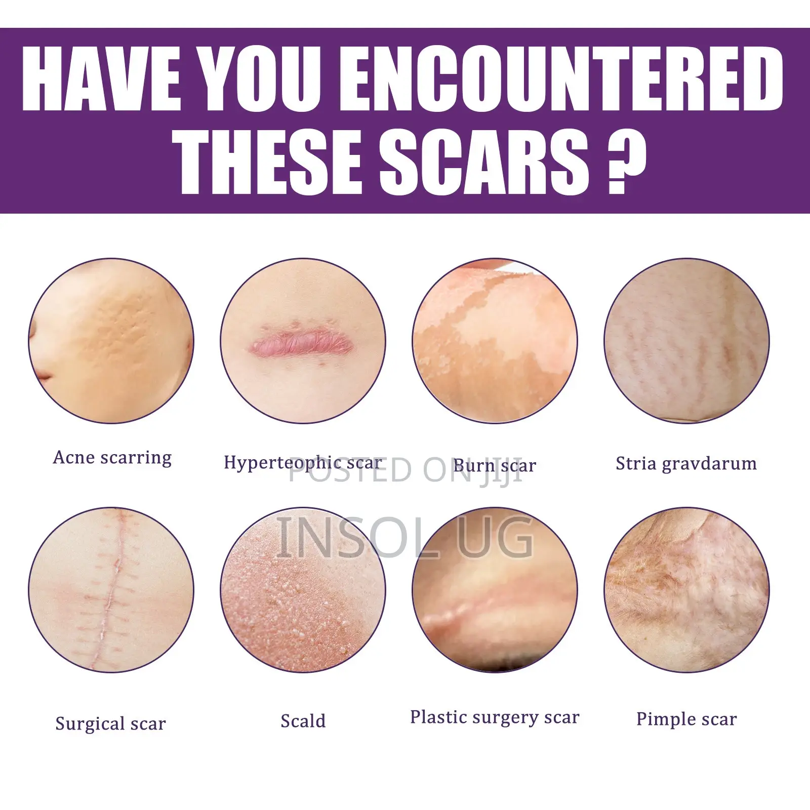 Silicone Scar Remover