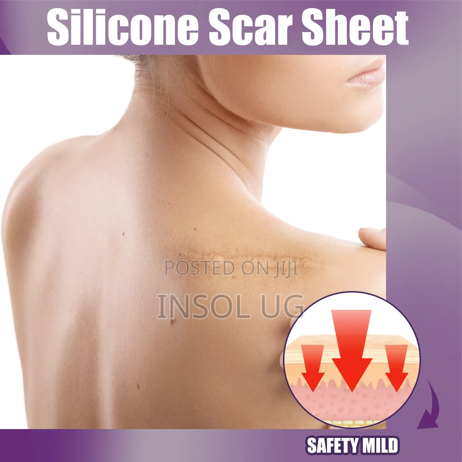 Silicone Scar Remover