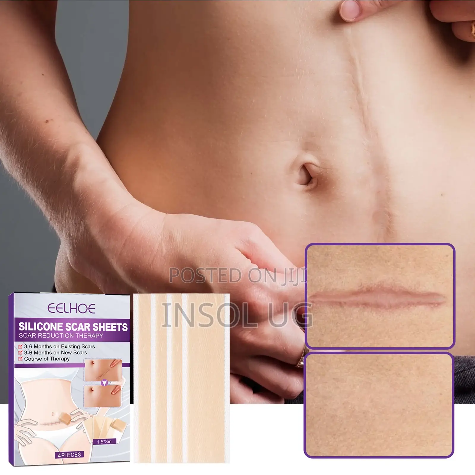 Silicone Scar Remover