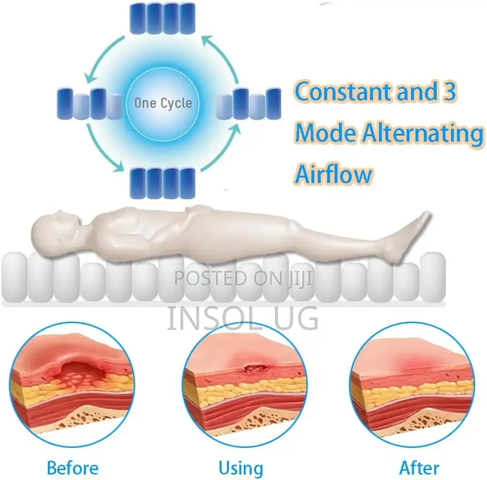 Alternating Pressure Pressure Relief Mattress.
