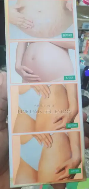 Orbit 2q Stretch Mark Lotion