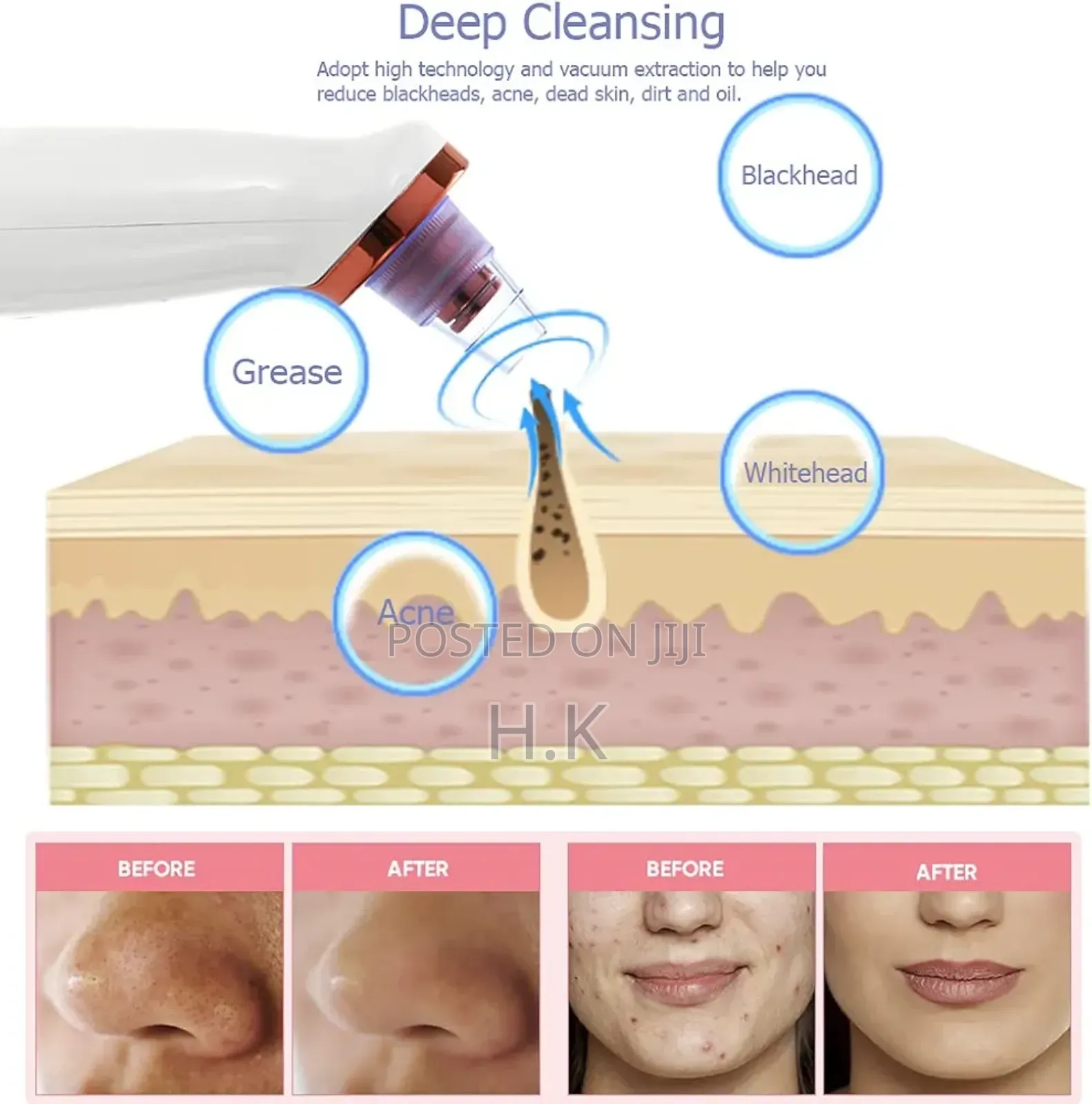 Black Head Remover