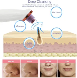 Black Head Remover