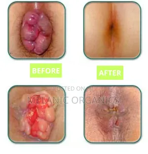 No More Hemorrhoids Oil