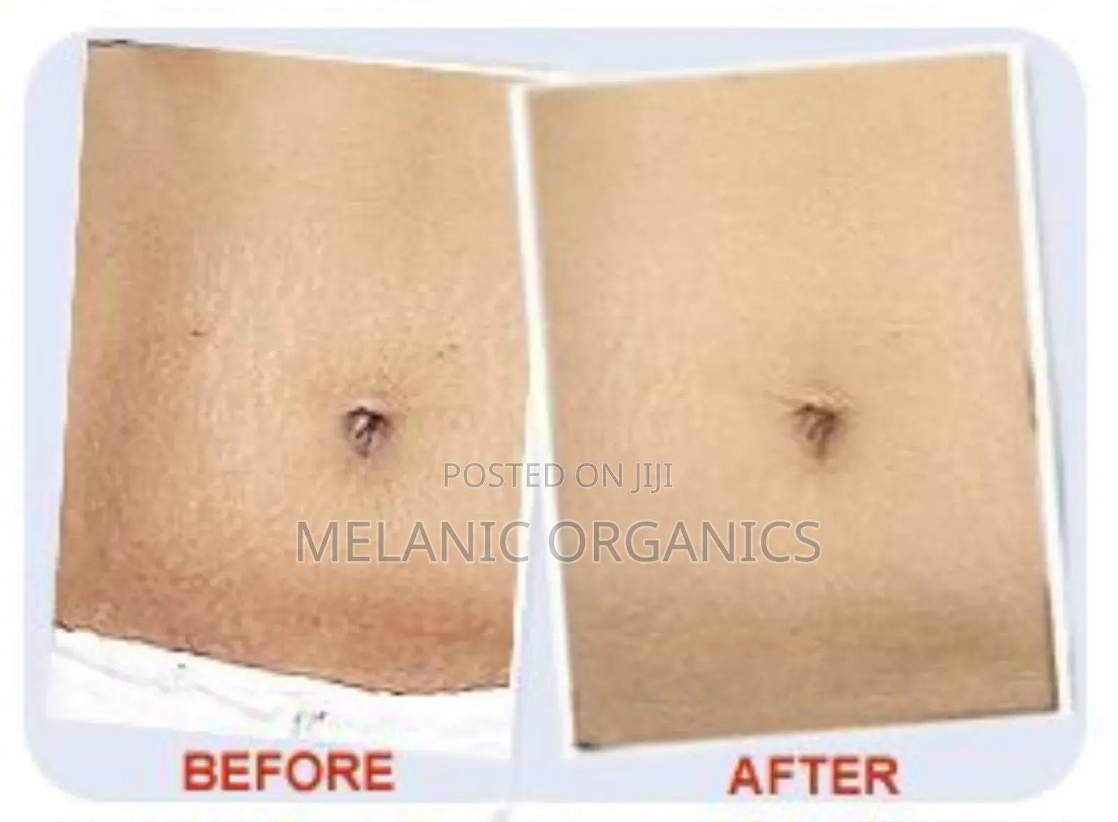 Stretch Mark Fading Oil