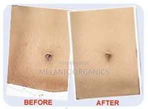 Stretch Mark Fading Oil