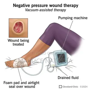 Negative Pressure Wound Therapy (First Wound Healing Machine)