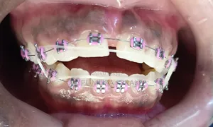 Dental Braces