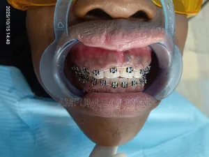 Dental Braces