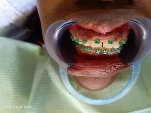 Dental Braces