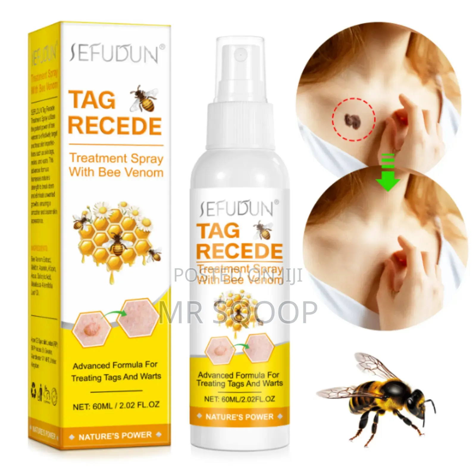 Skin Tag Wart Removal Spray With Bee Venom – Fast Acting