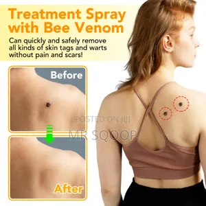 Skin Tag Wart Removal Spray With Bee Venom – Fast Acting