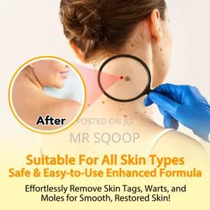 Skin Tag Wart Removal Spray With Bee Venom – Fast Acting