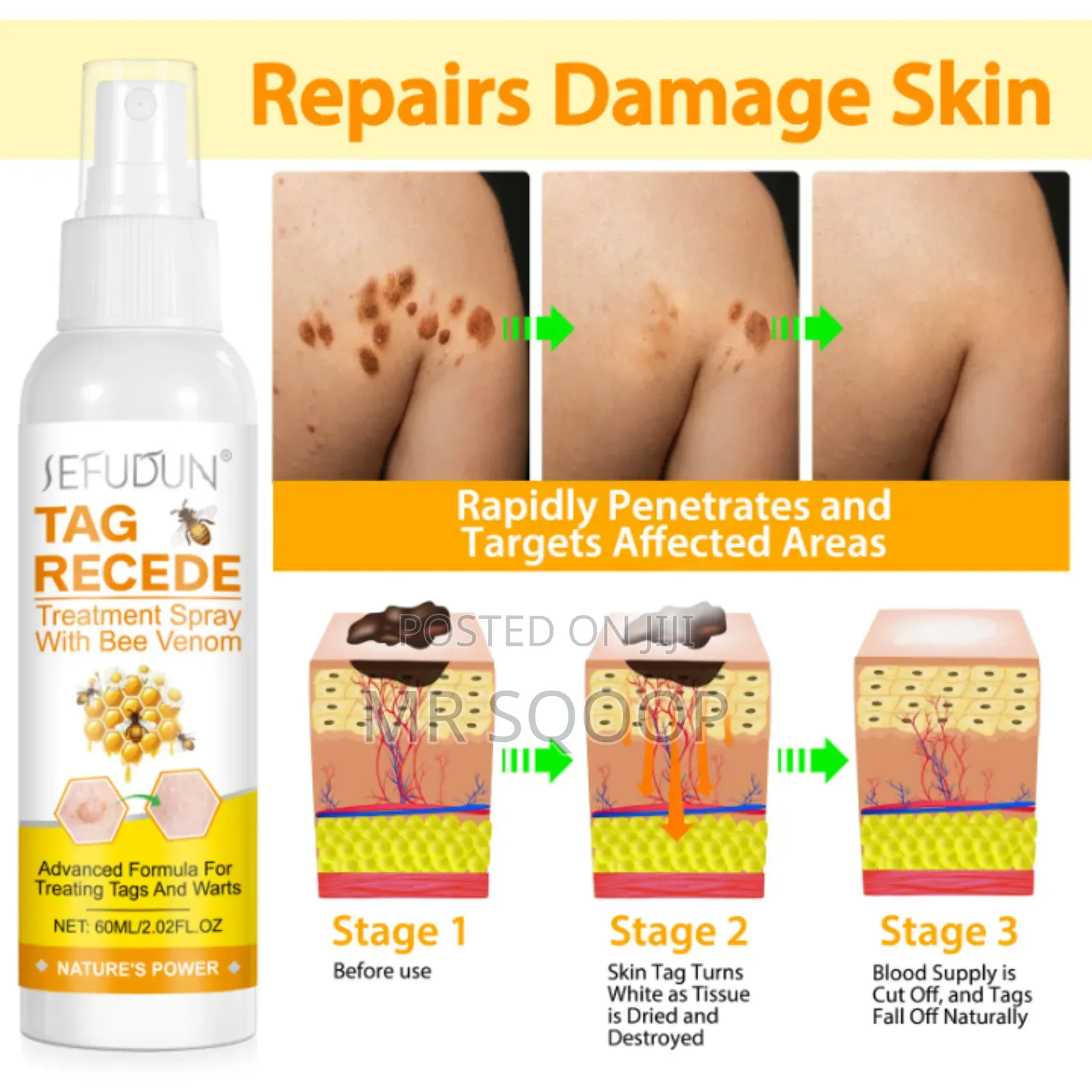 Skin Tag Wart Removal Spray With Bee Venom – Fast Acting